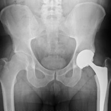 Non-Invasive Hip Replacement Surgery